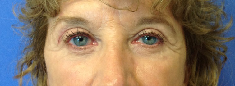 Eyelid Surgery Results Fort Myers